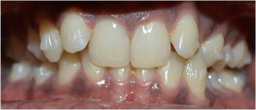 Invisalign - Before