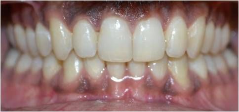 Invisalign - After