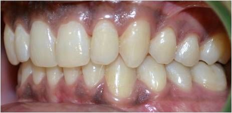 Invisalign - After