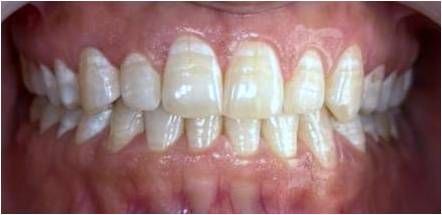 Invisalign - After