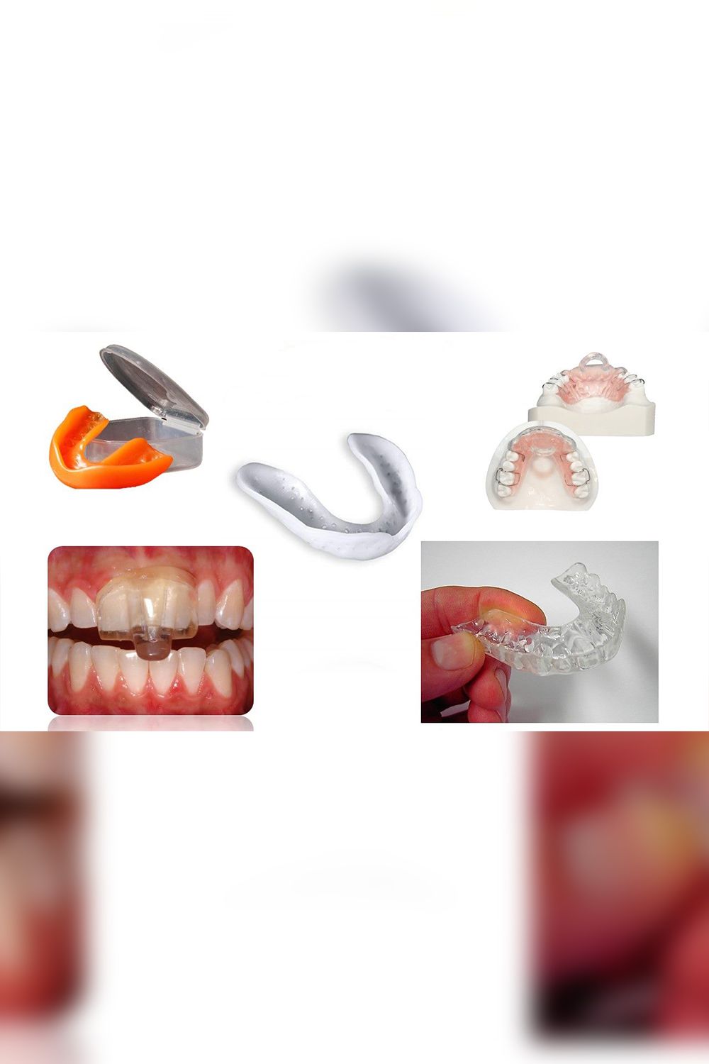 Night Grinding or Bruxism