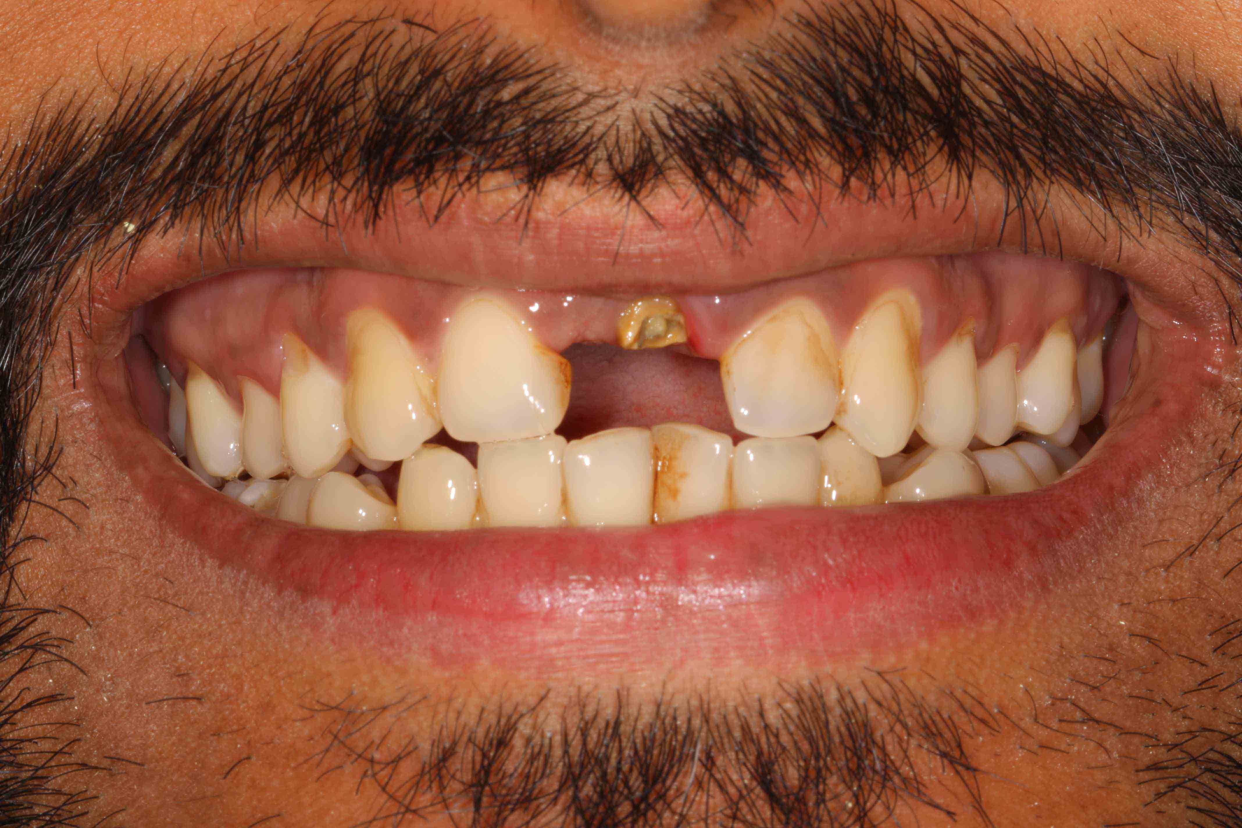 Braces Transformation - Before