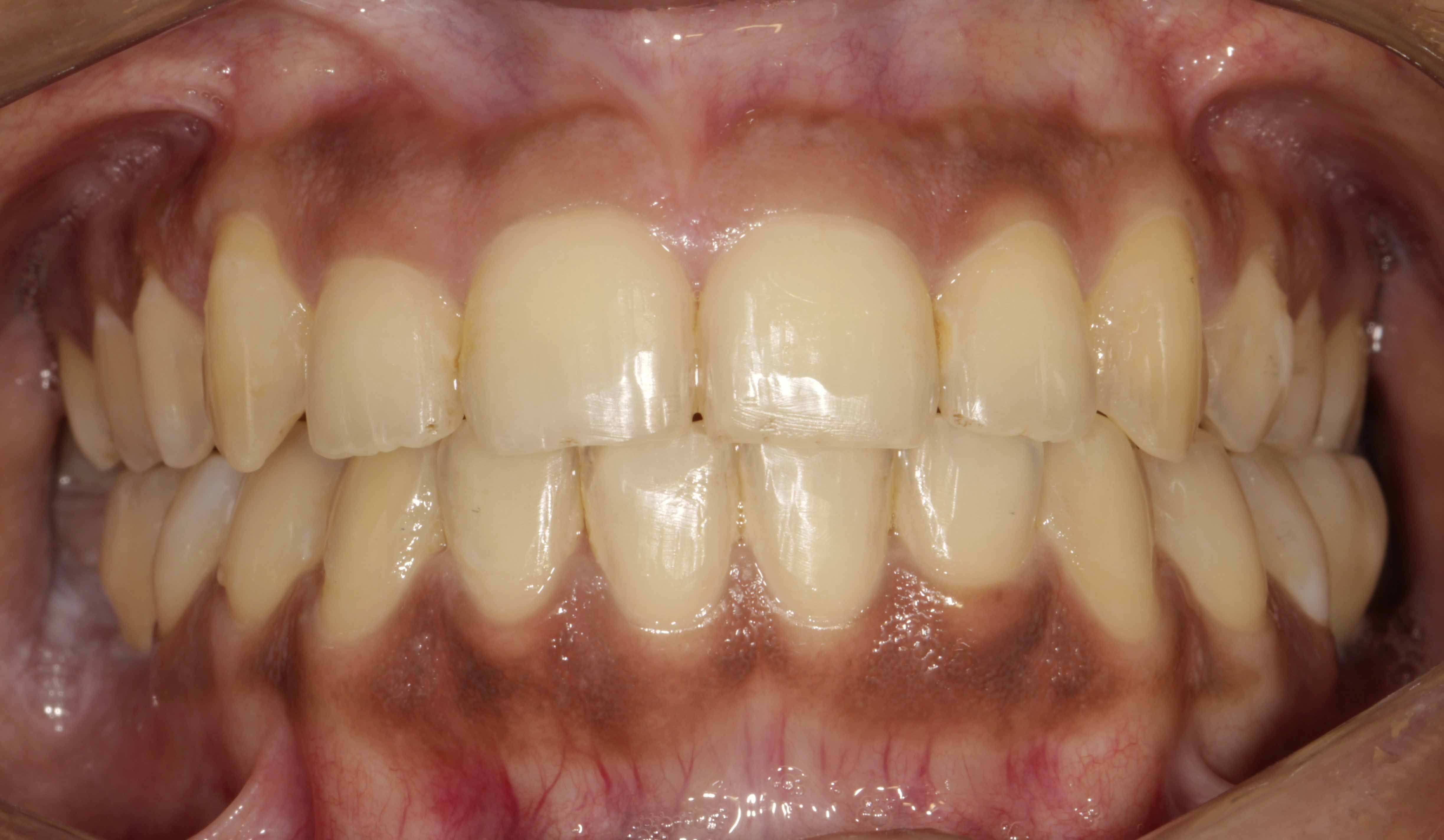 Clear Aligners Result - After