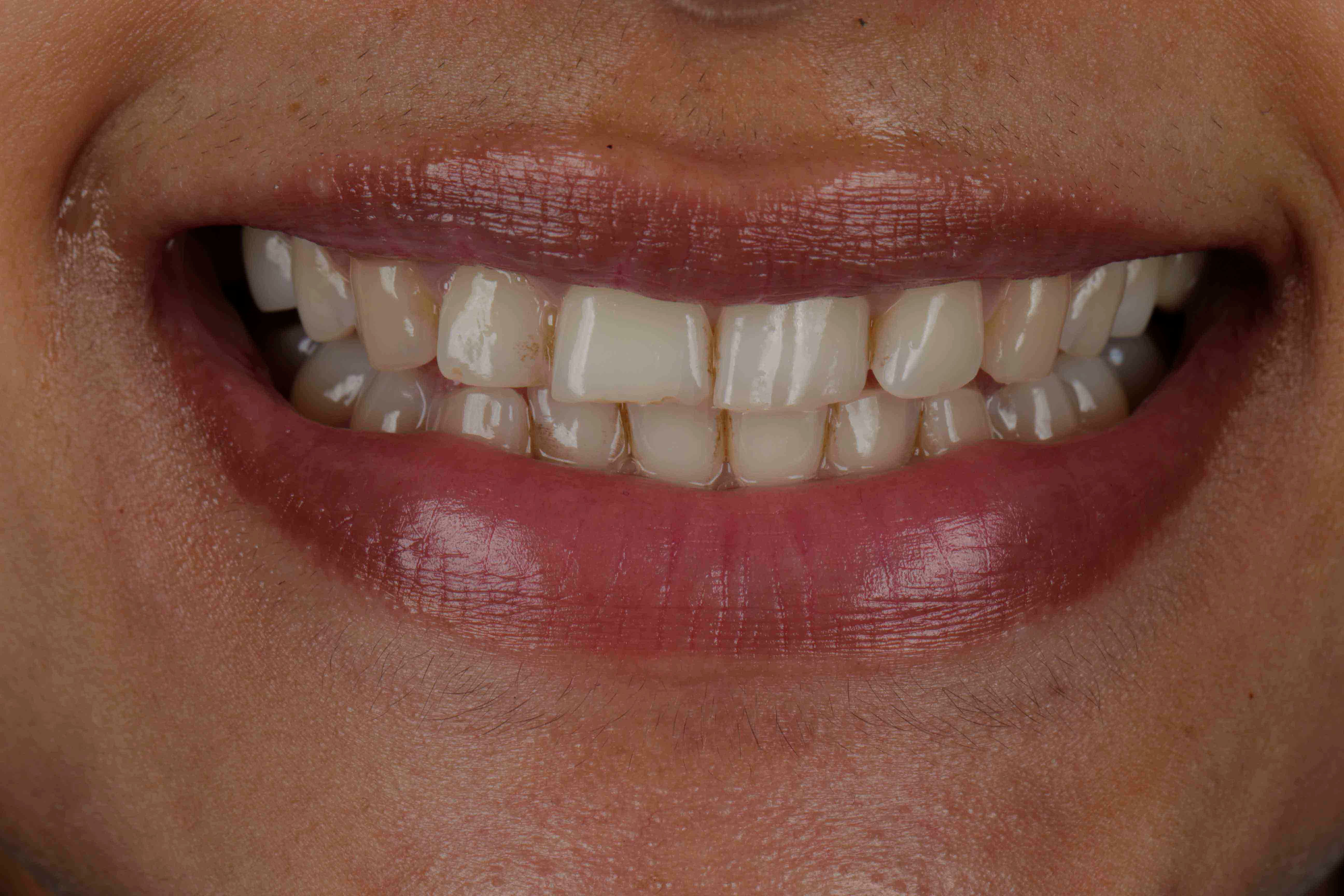 Clear Aligners Result - Before