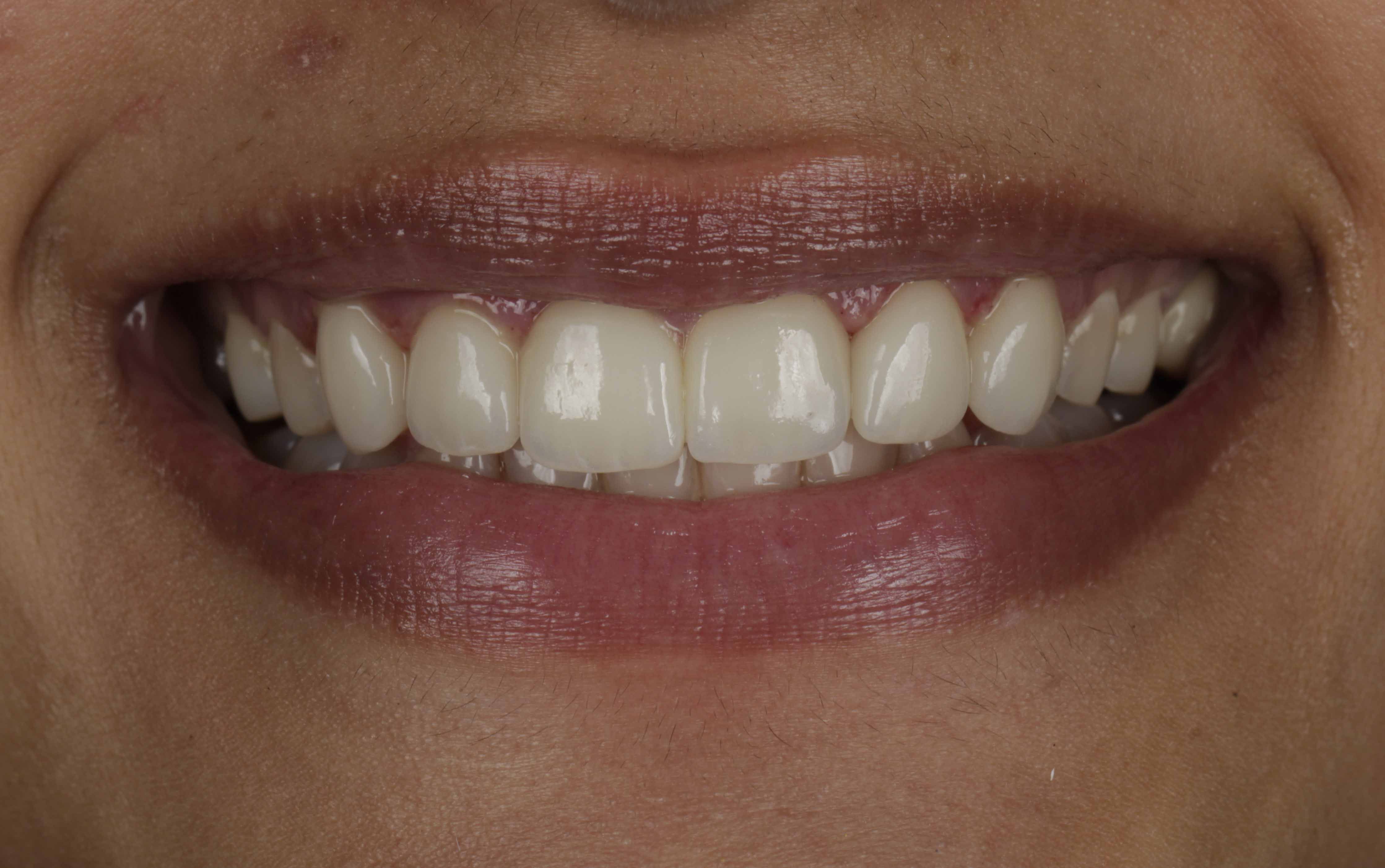 Clear Aligners Result - After