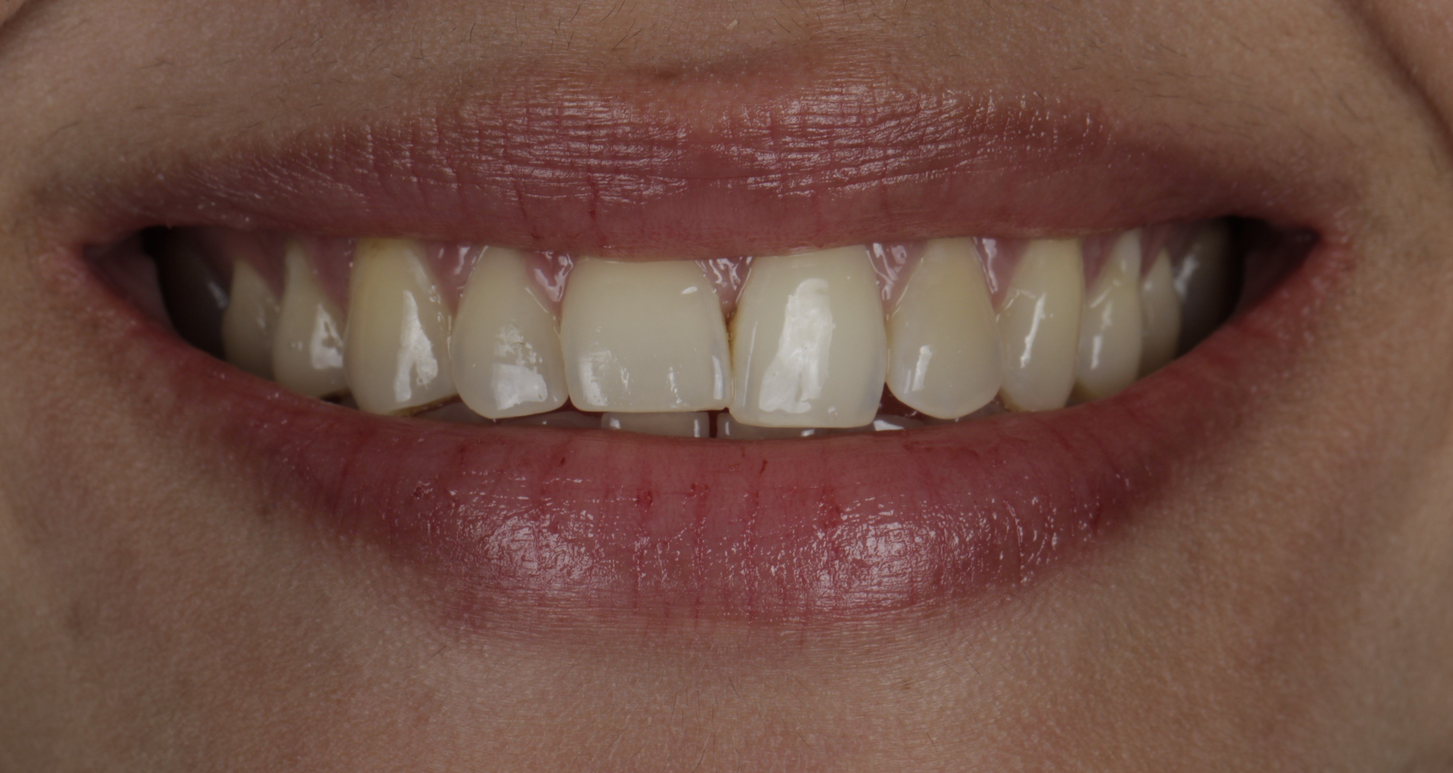 Clear Aligners Result - Before