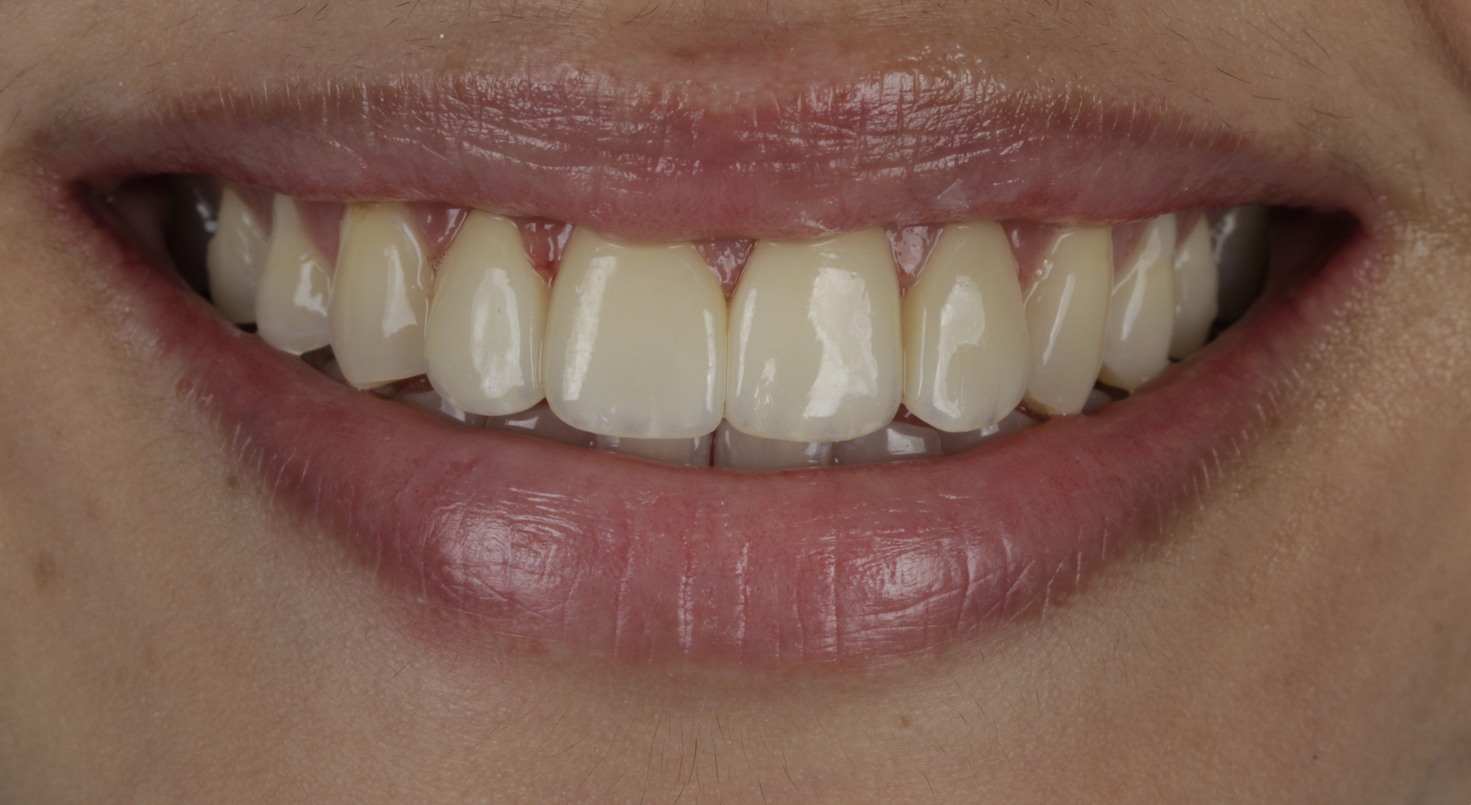 Clear Aligners Result - After