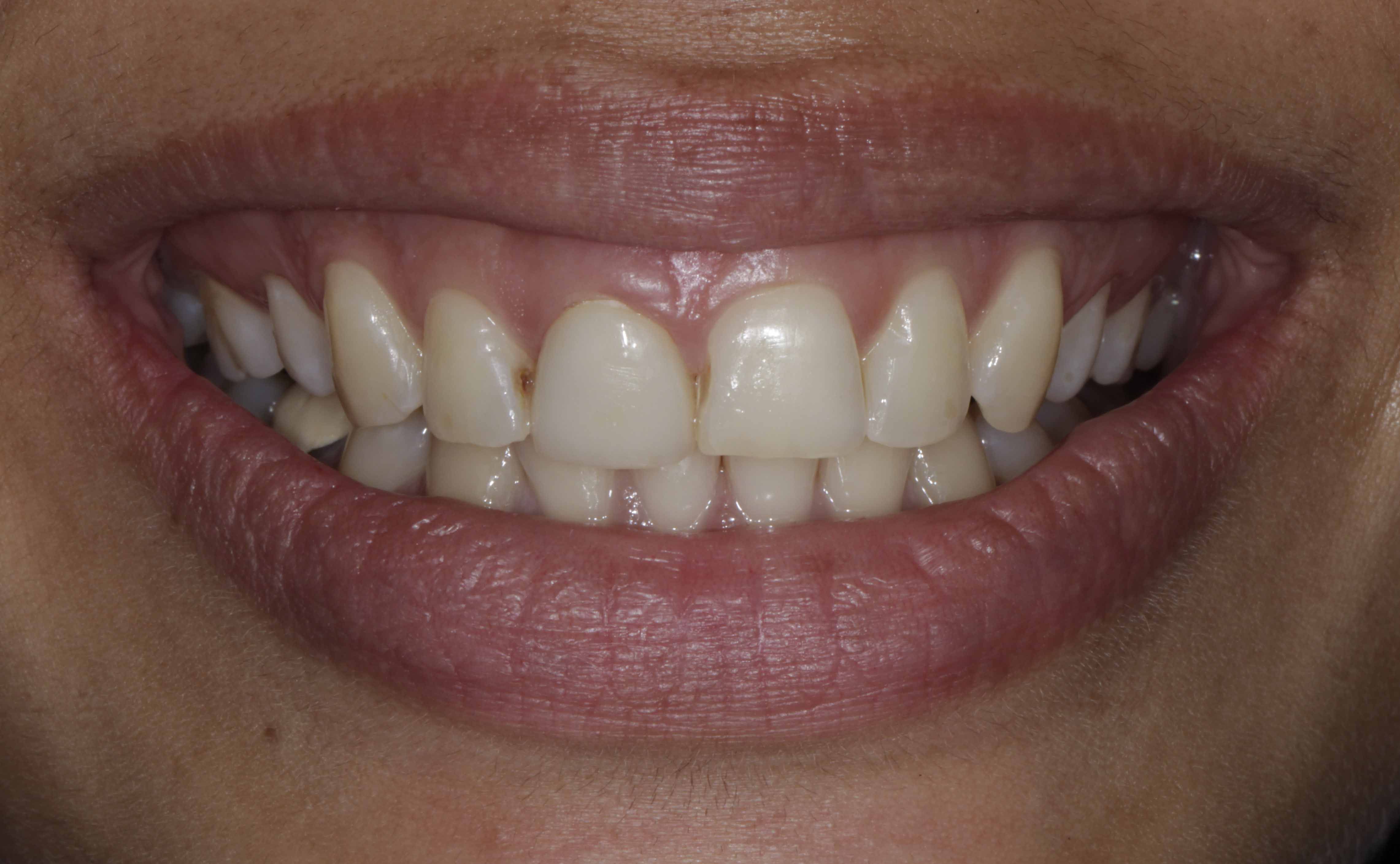 Clear Aligners Result" - Before