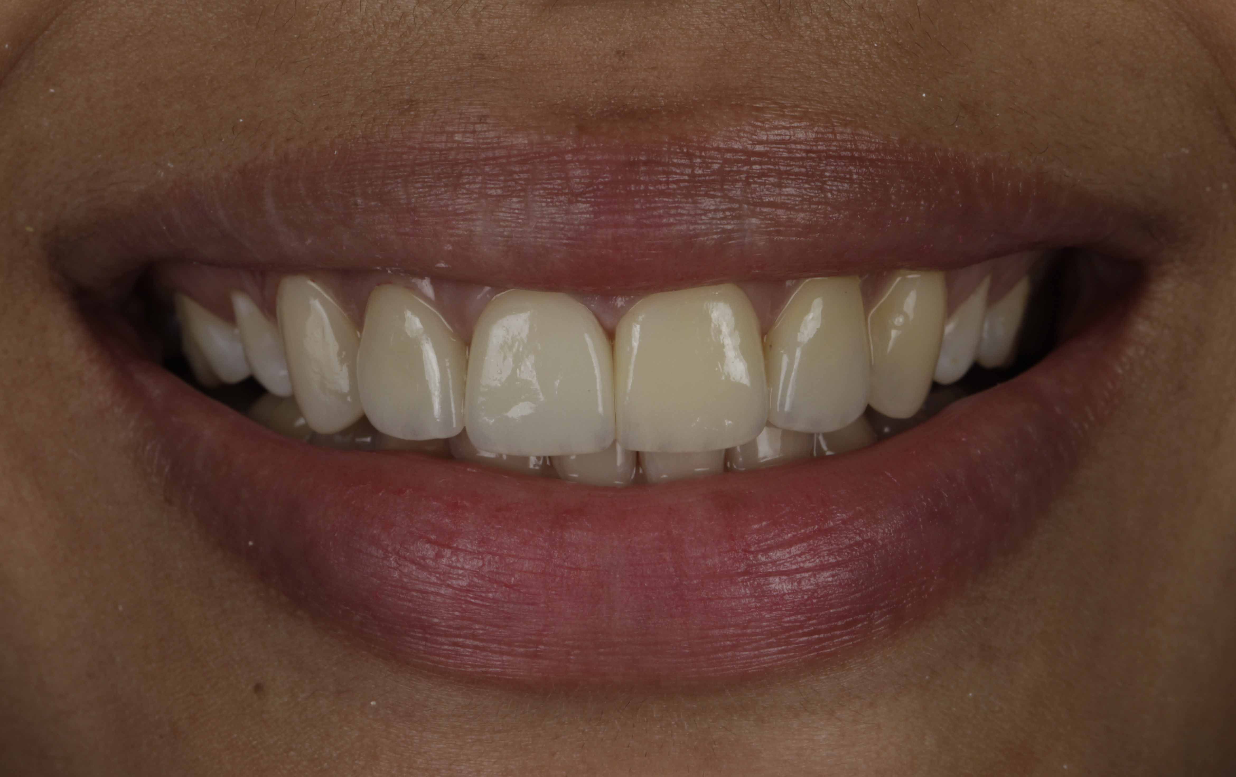 Clear Aligners Result" - After