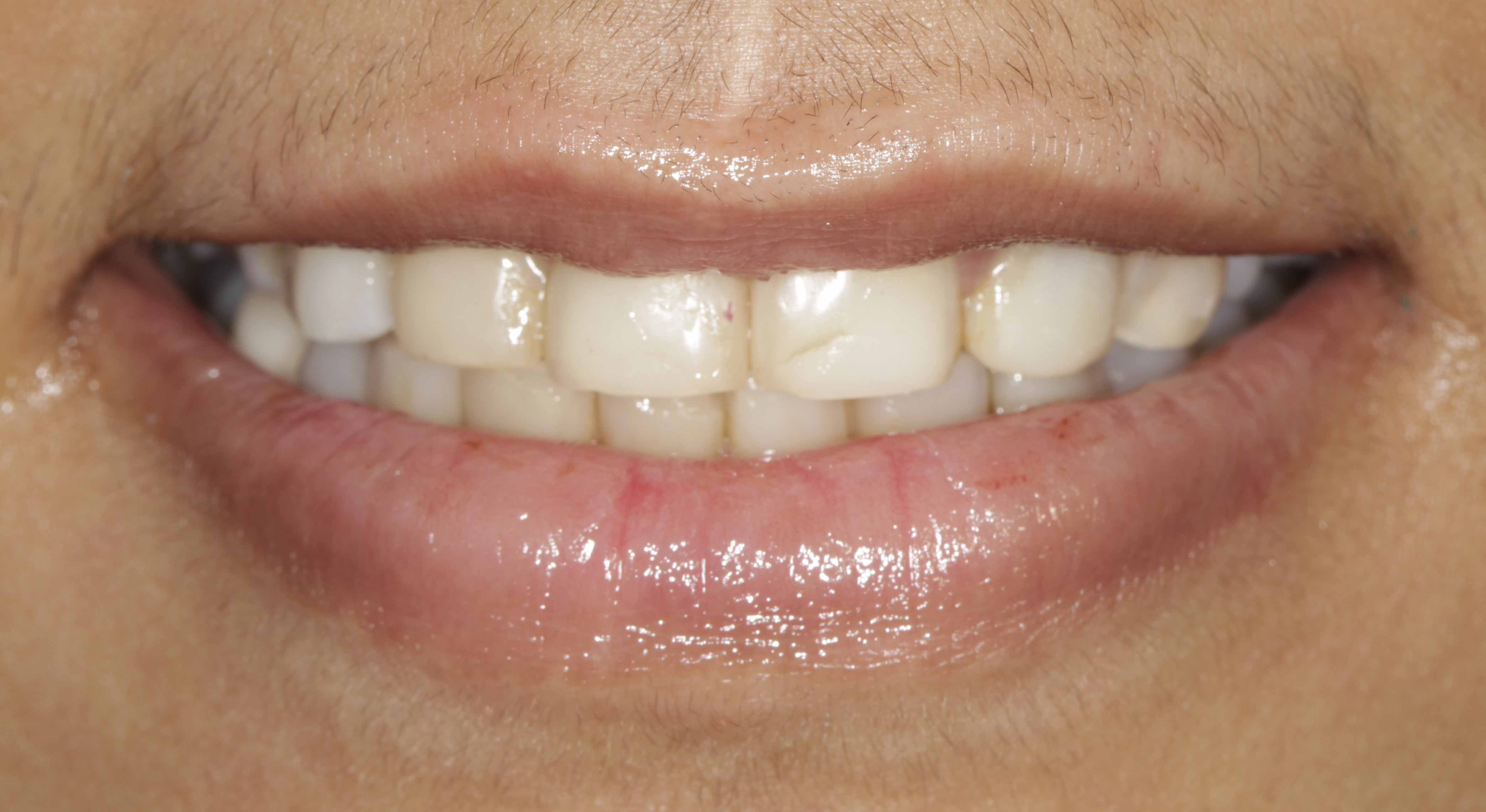 Braces Transformation - Before