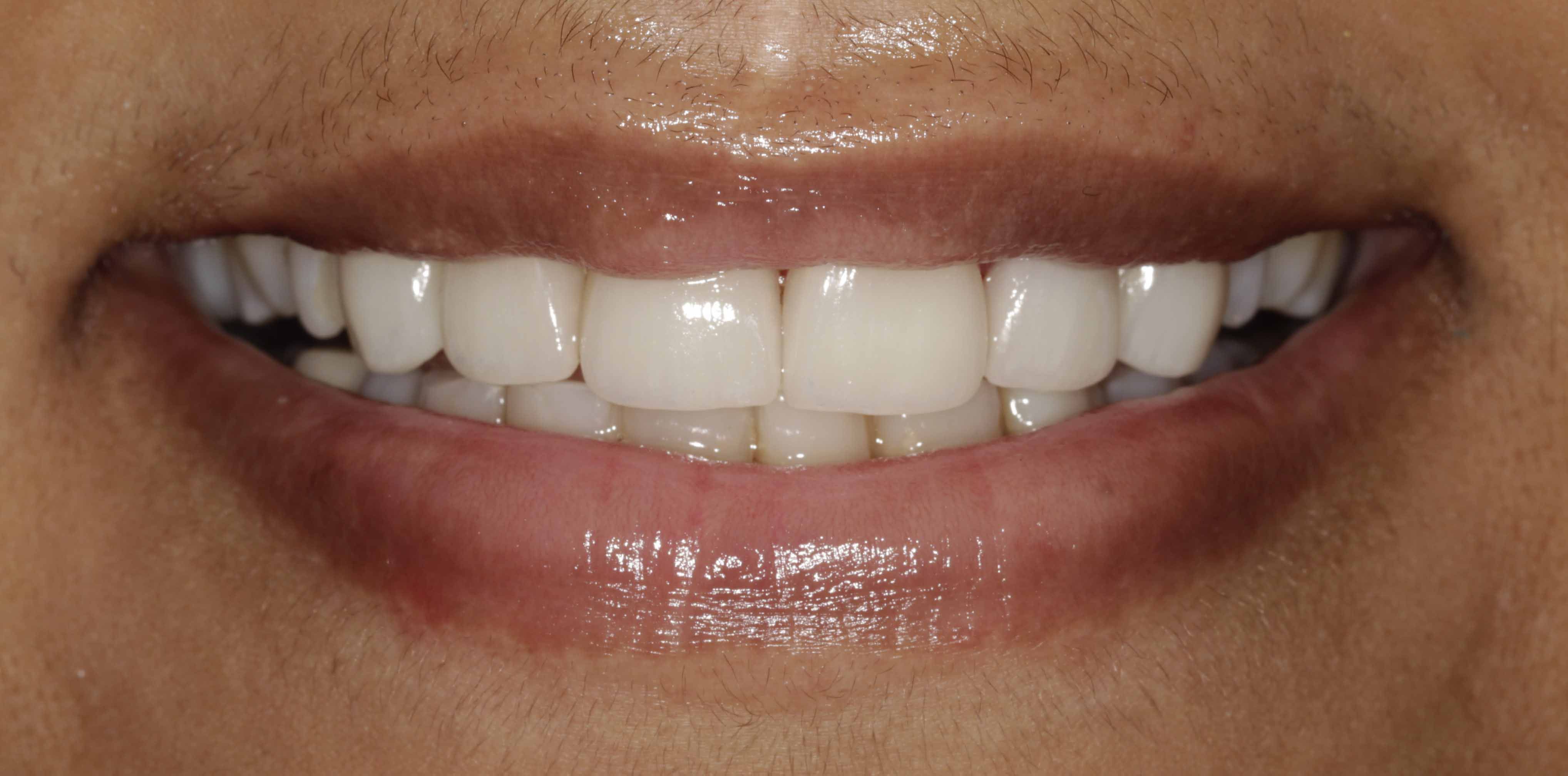 Braces Transformation - After