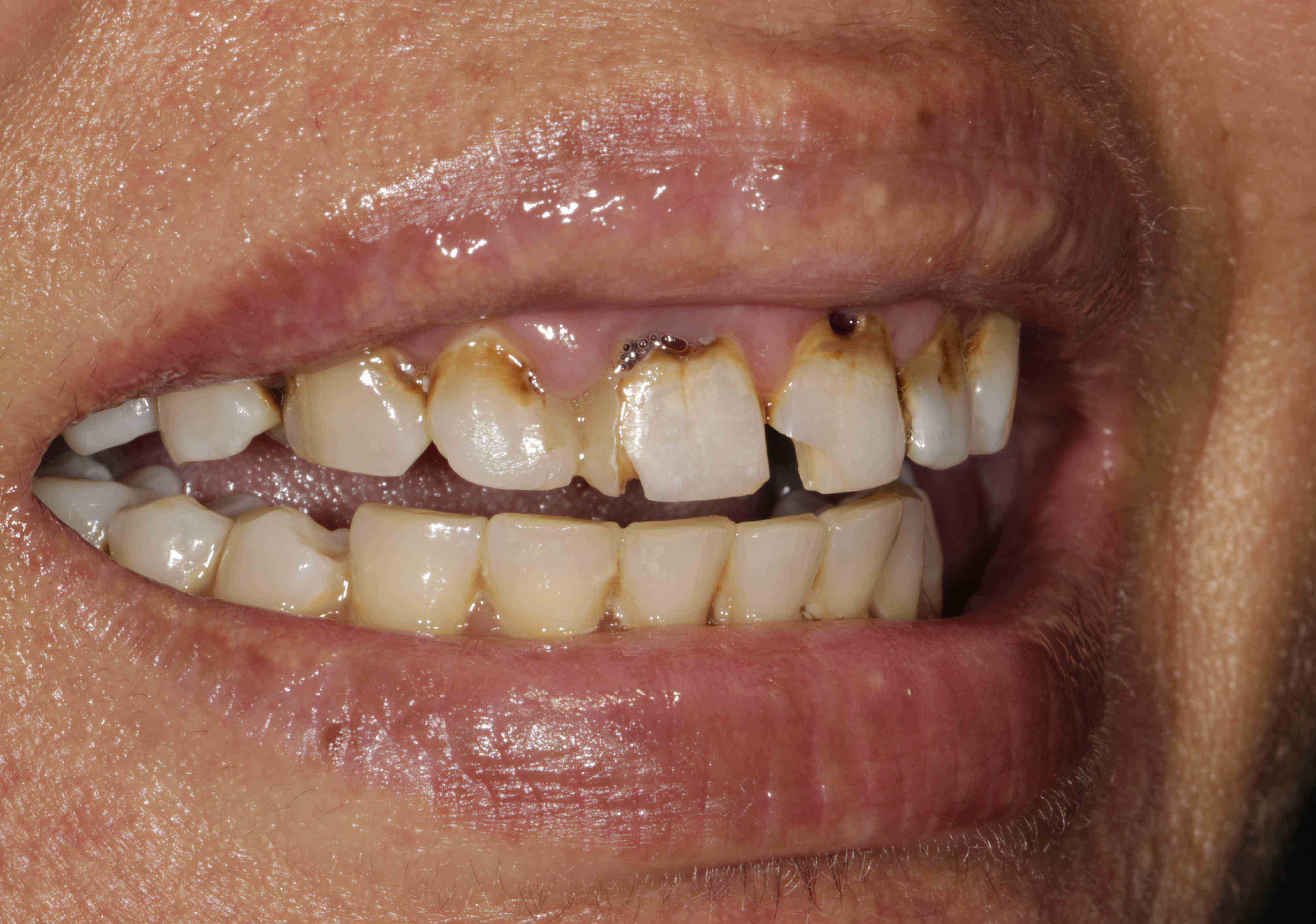 Clear Aligners Result - Before
