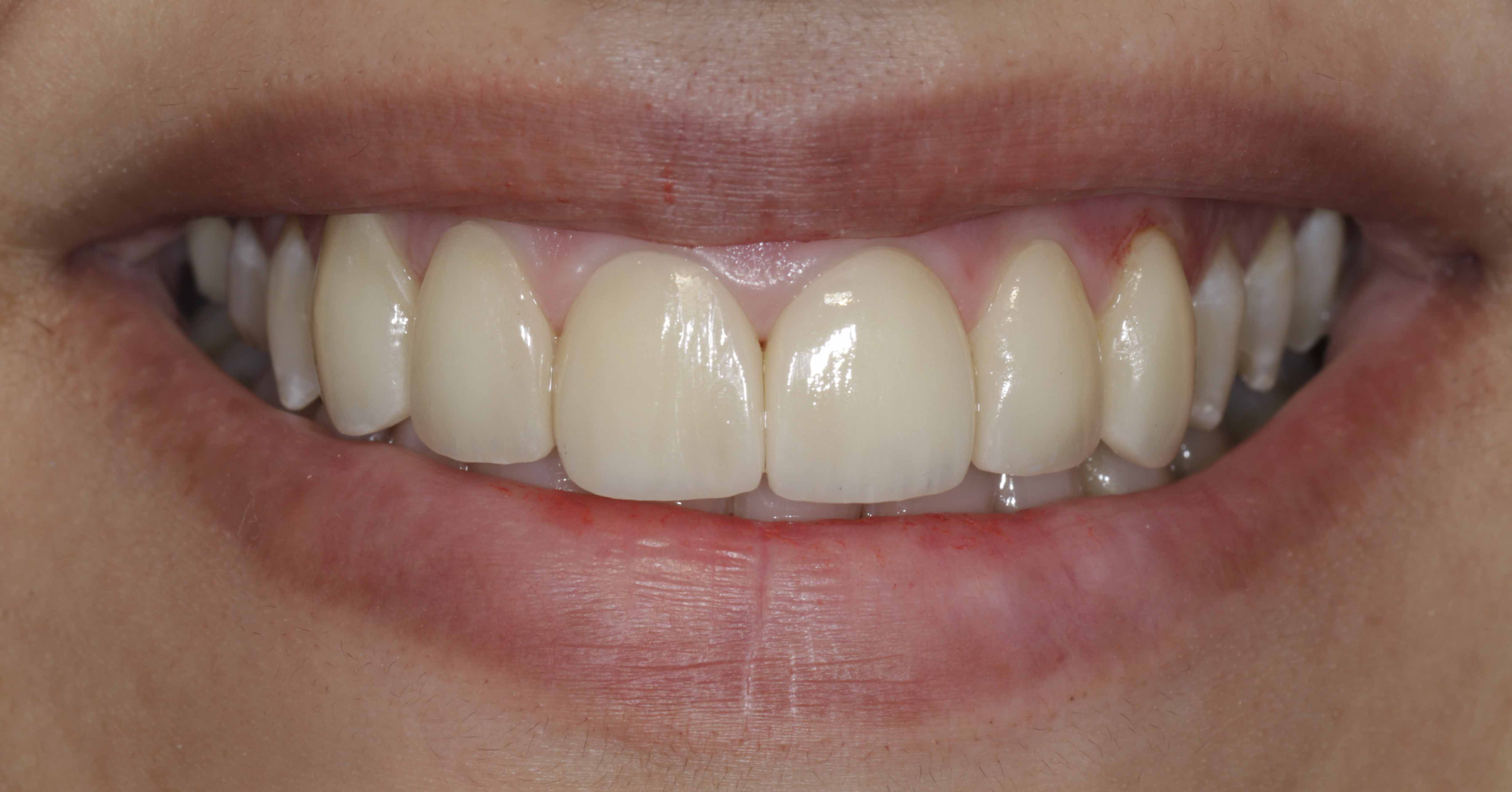 Clear Aligners Result - After