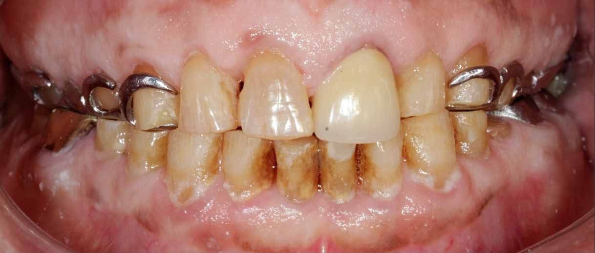 Braces Transformation - Before