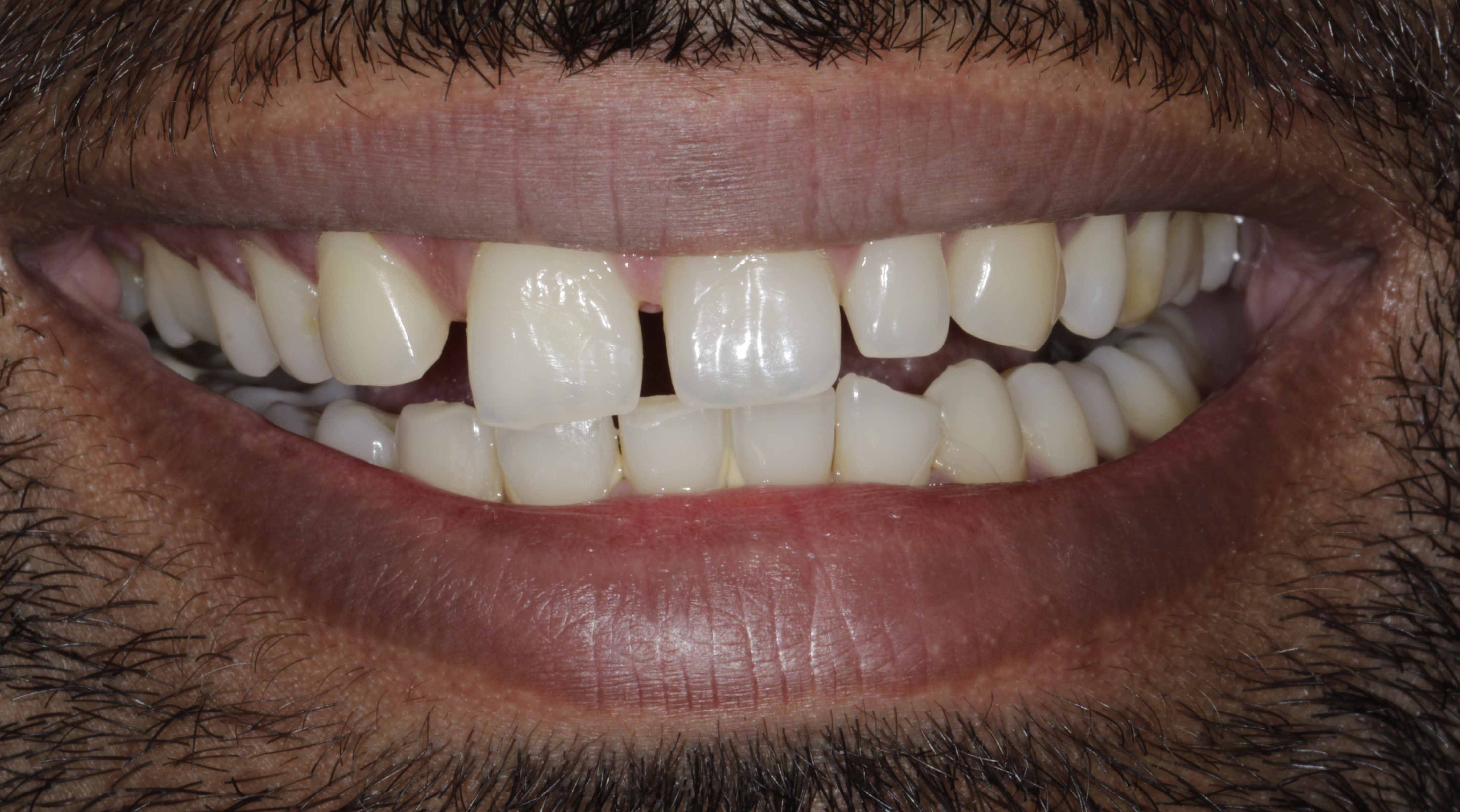 Clear Aligners Result - Before