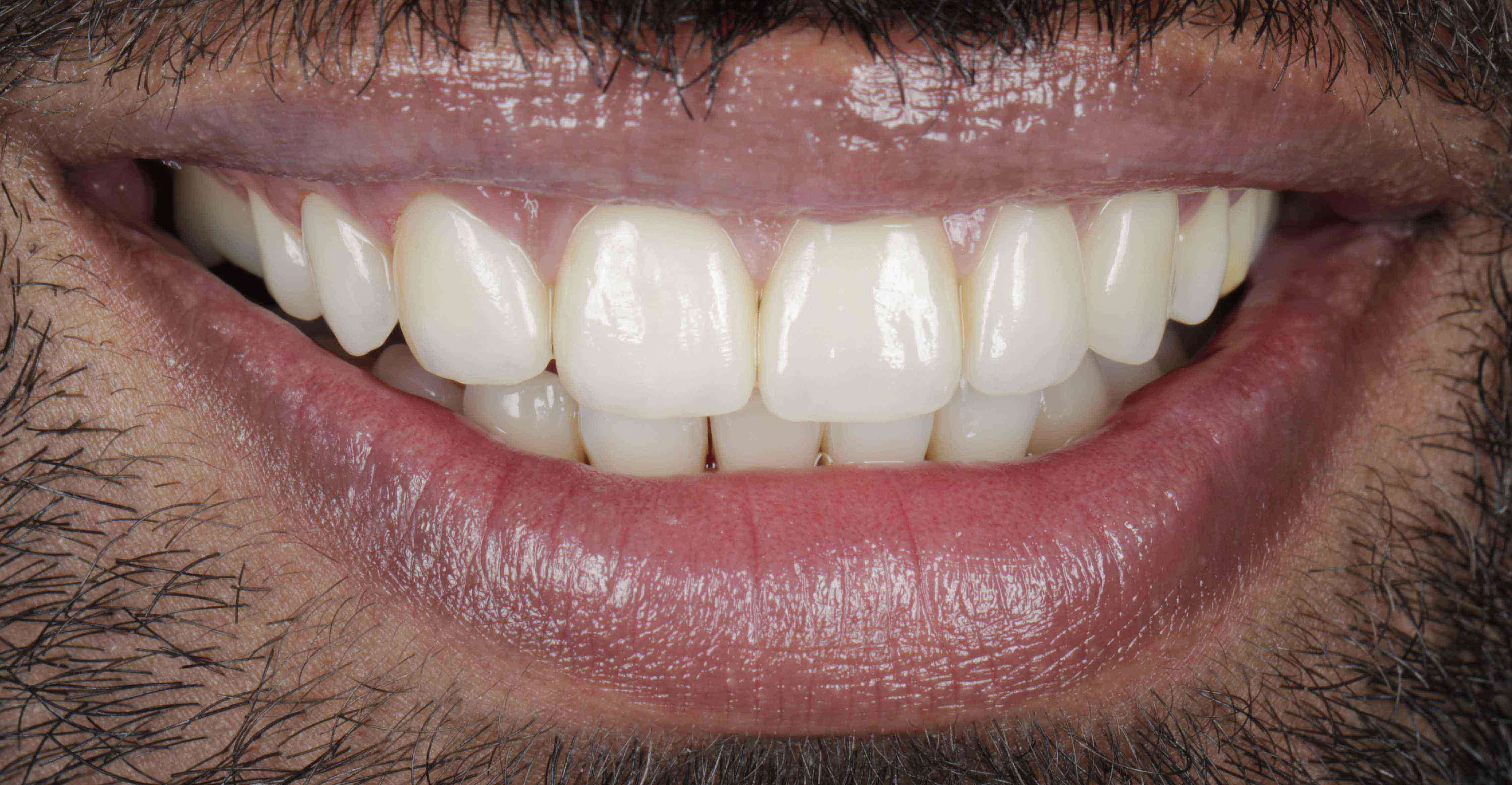 Clear Aligners Result - After