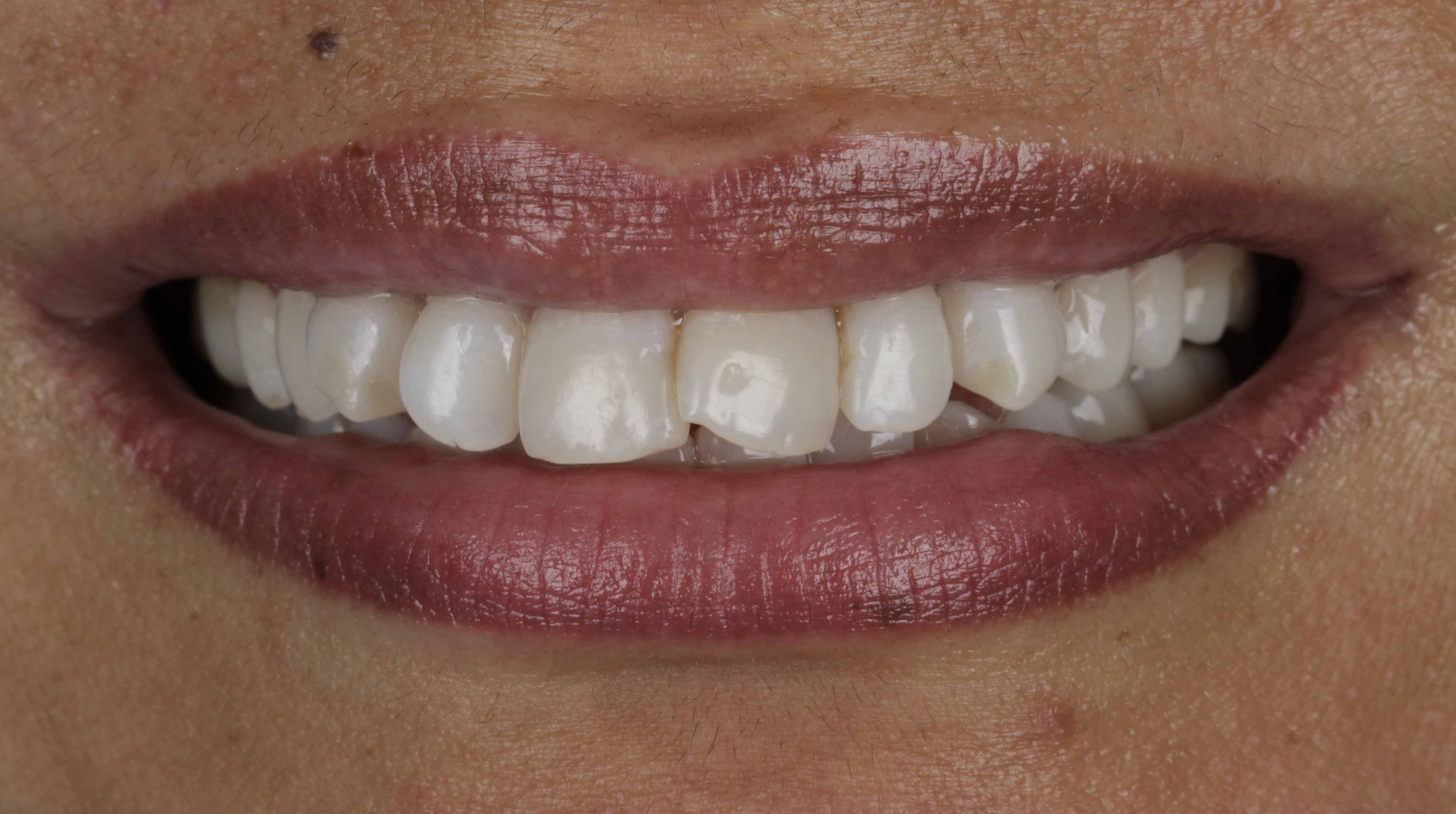 Clear Aligners Result - Before