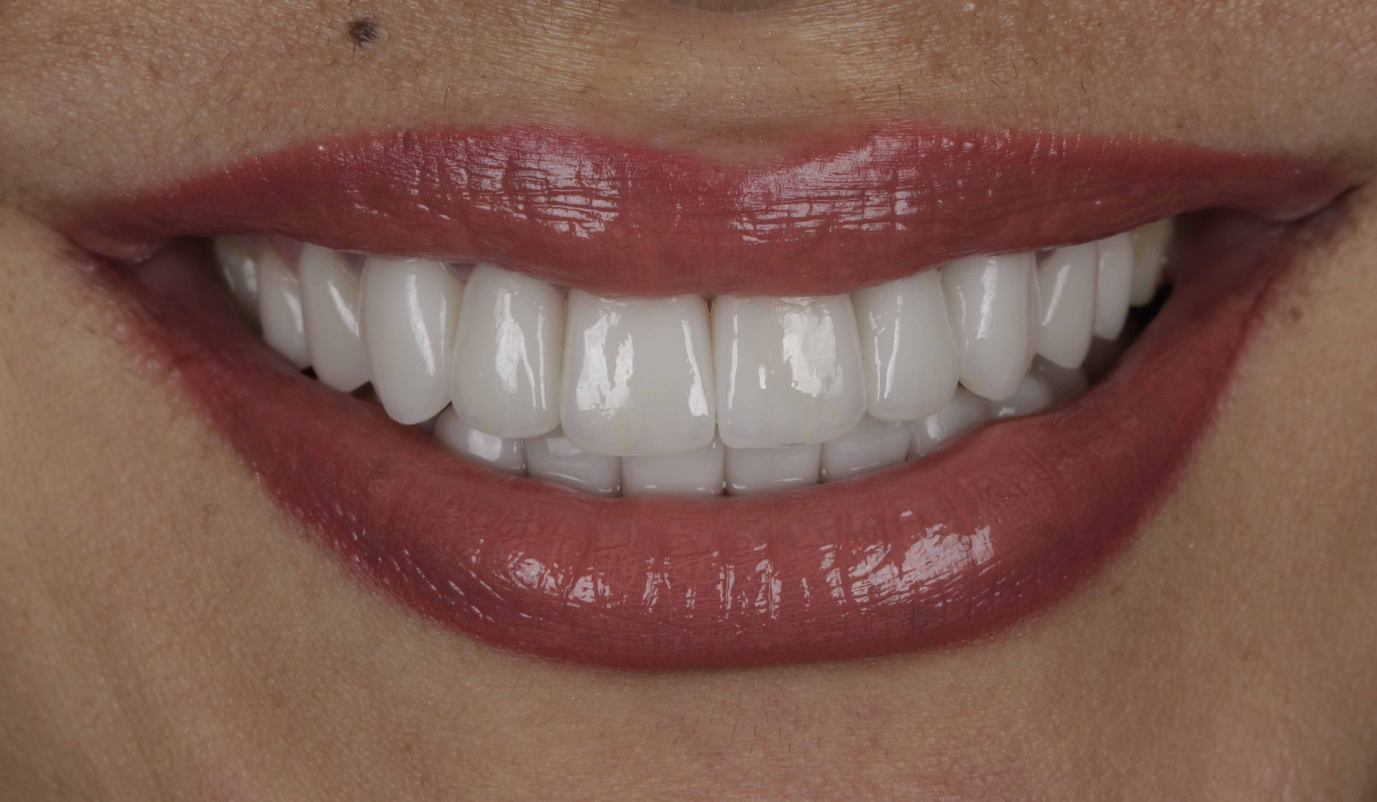 Clear Aligners Result - After