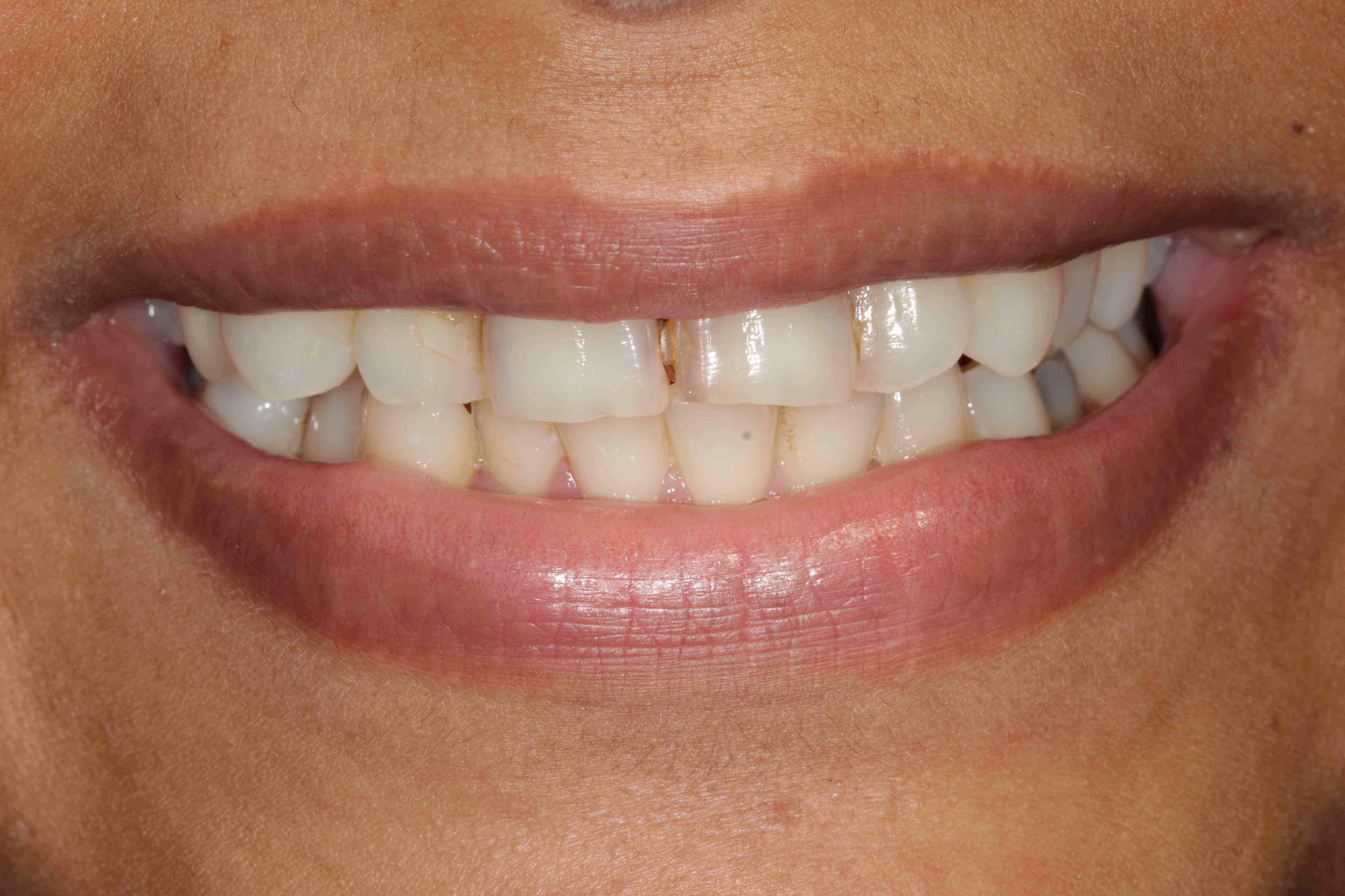 Braces Transformation - Before