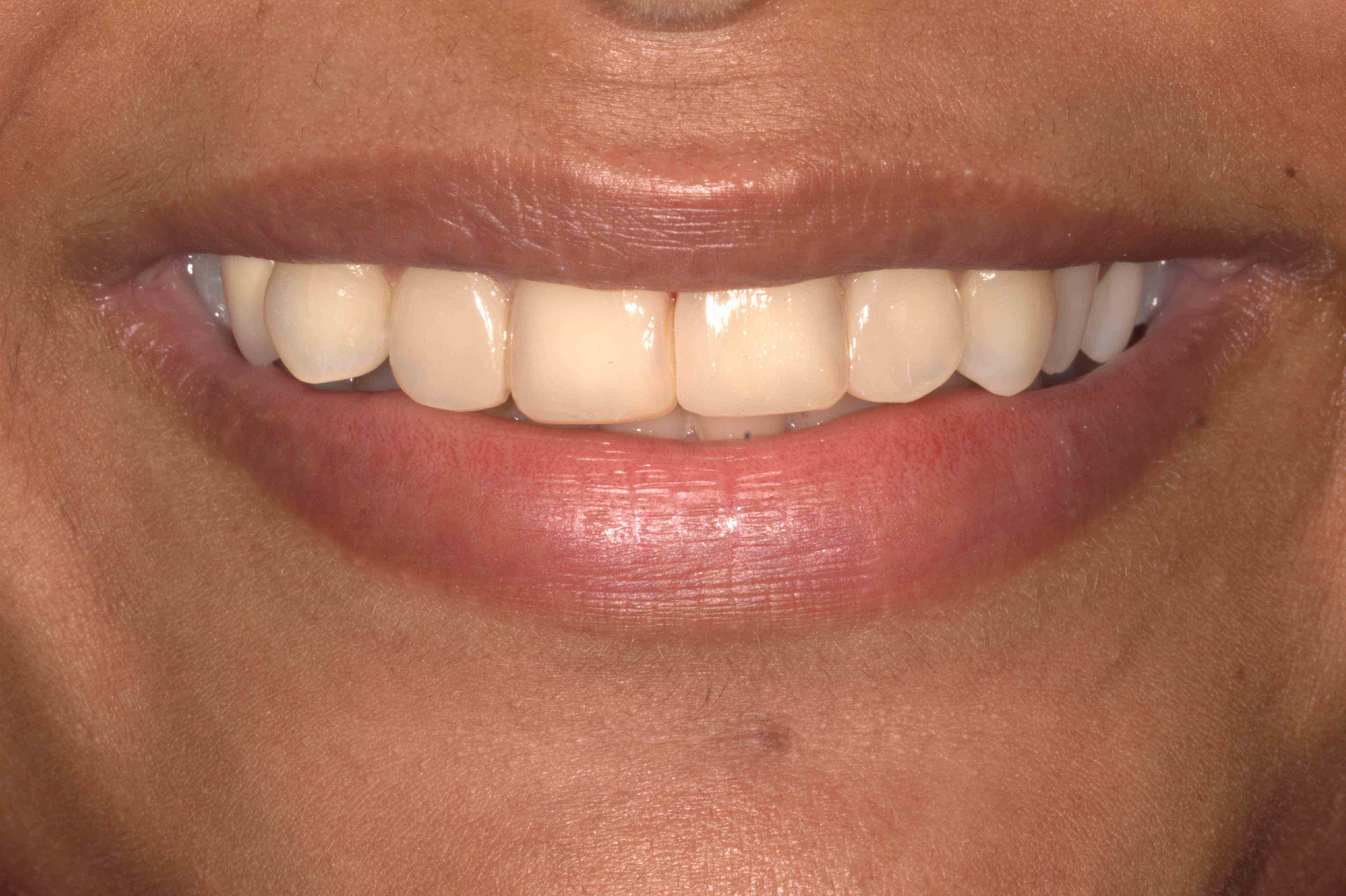 Braces Transformation - After