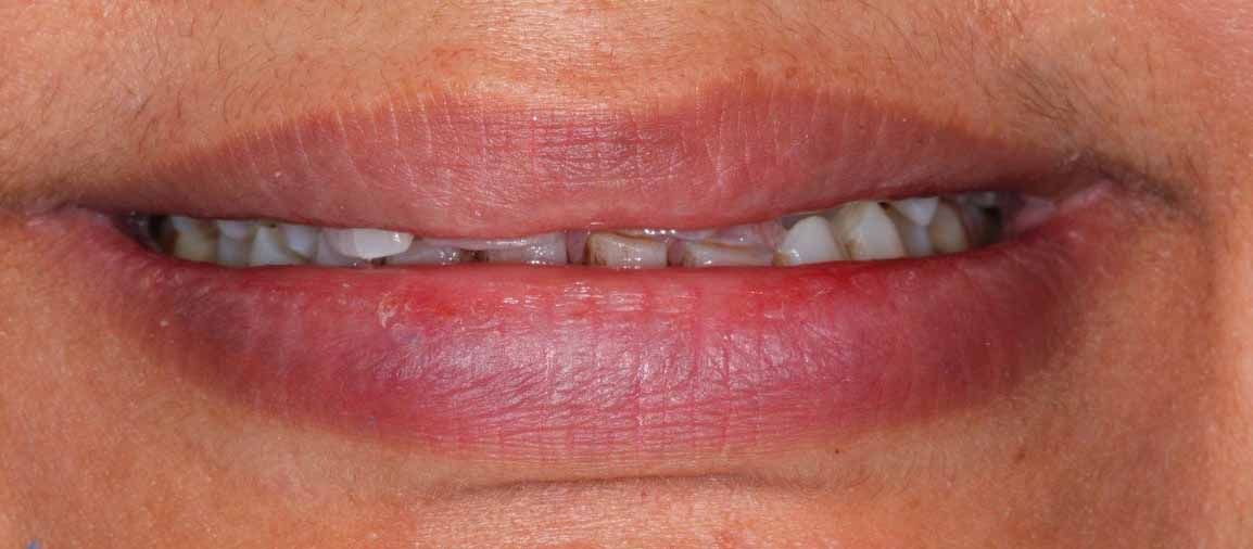 Clear Aligners Result - Before