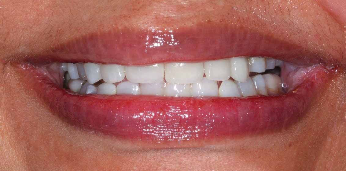 Clear Aligners Result - After