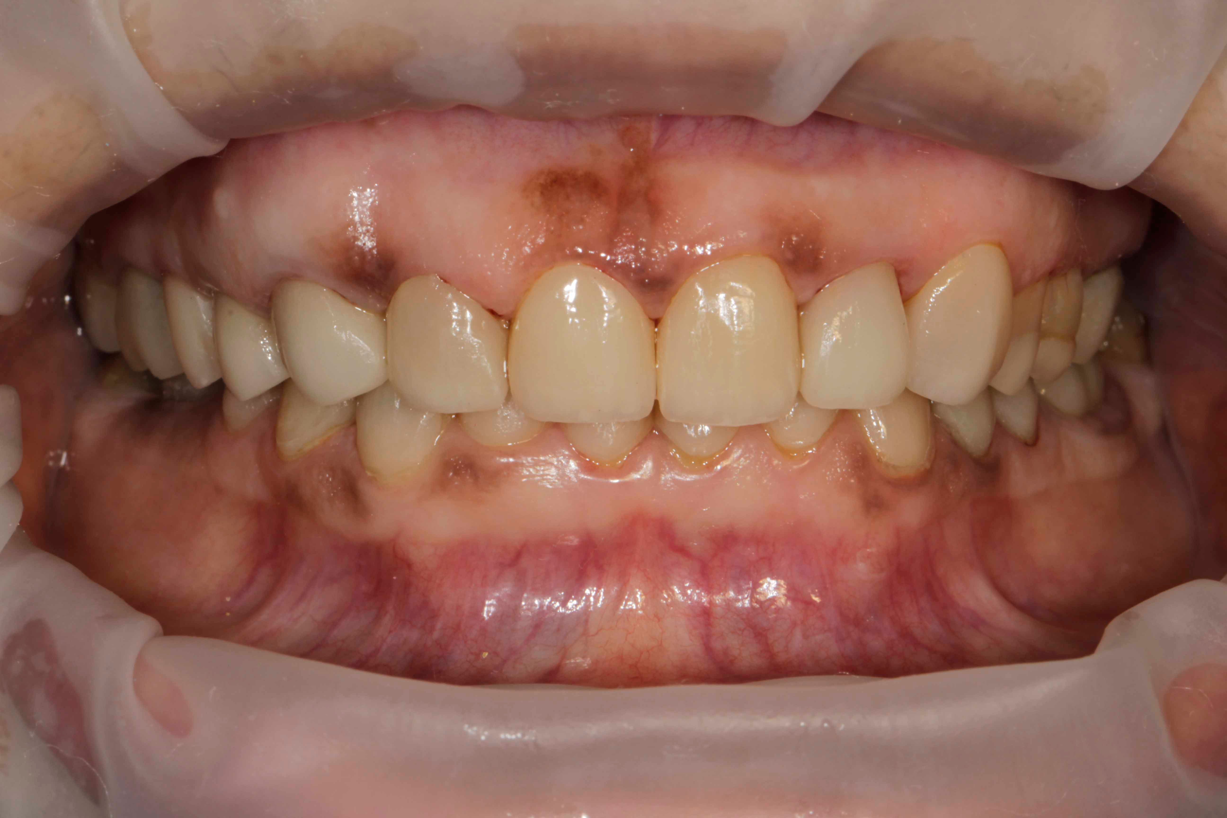 Clear Aligners Result - After