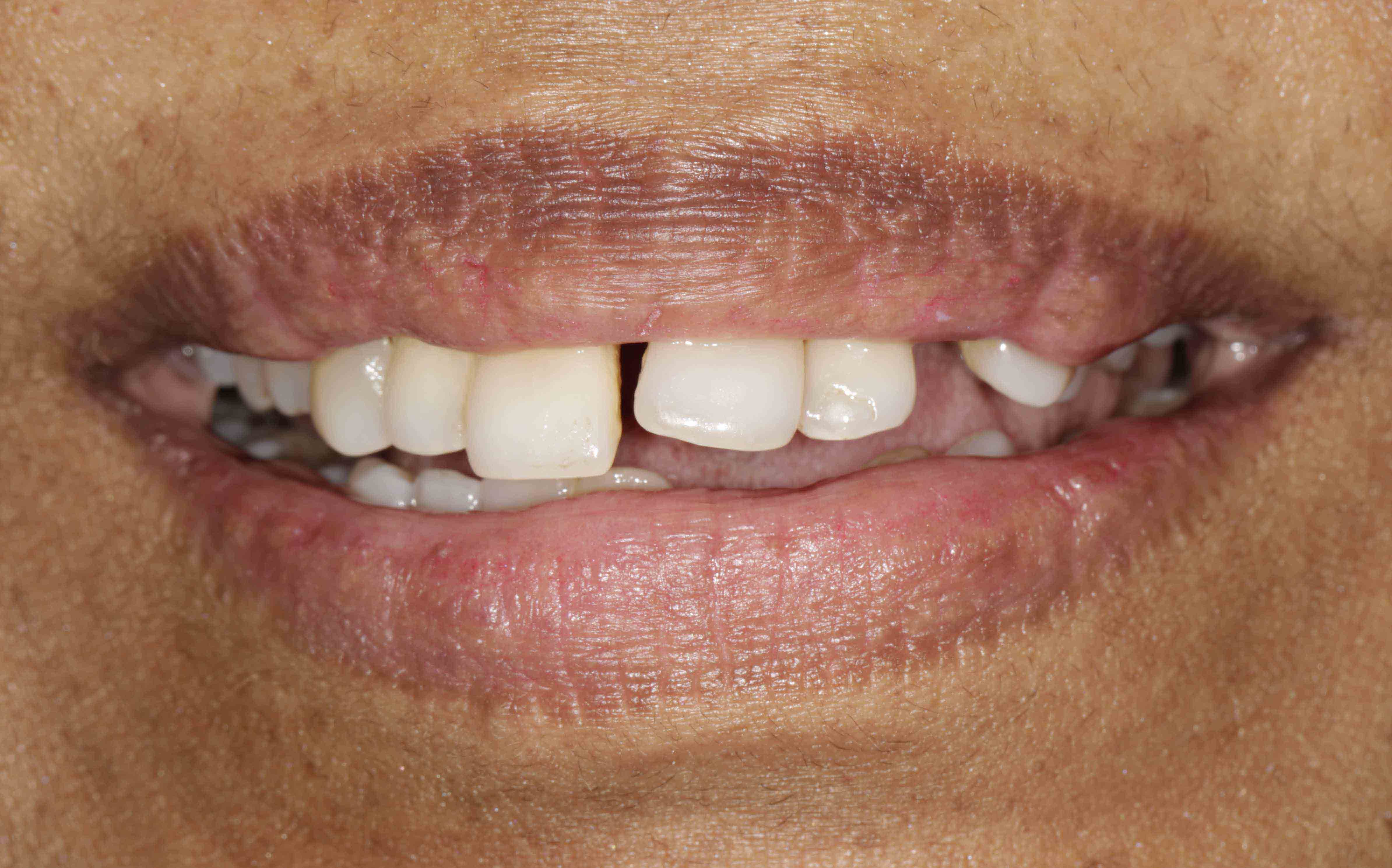 Braces Transformation - Before