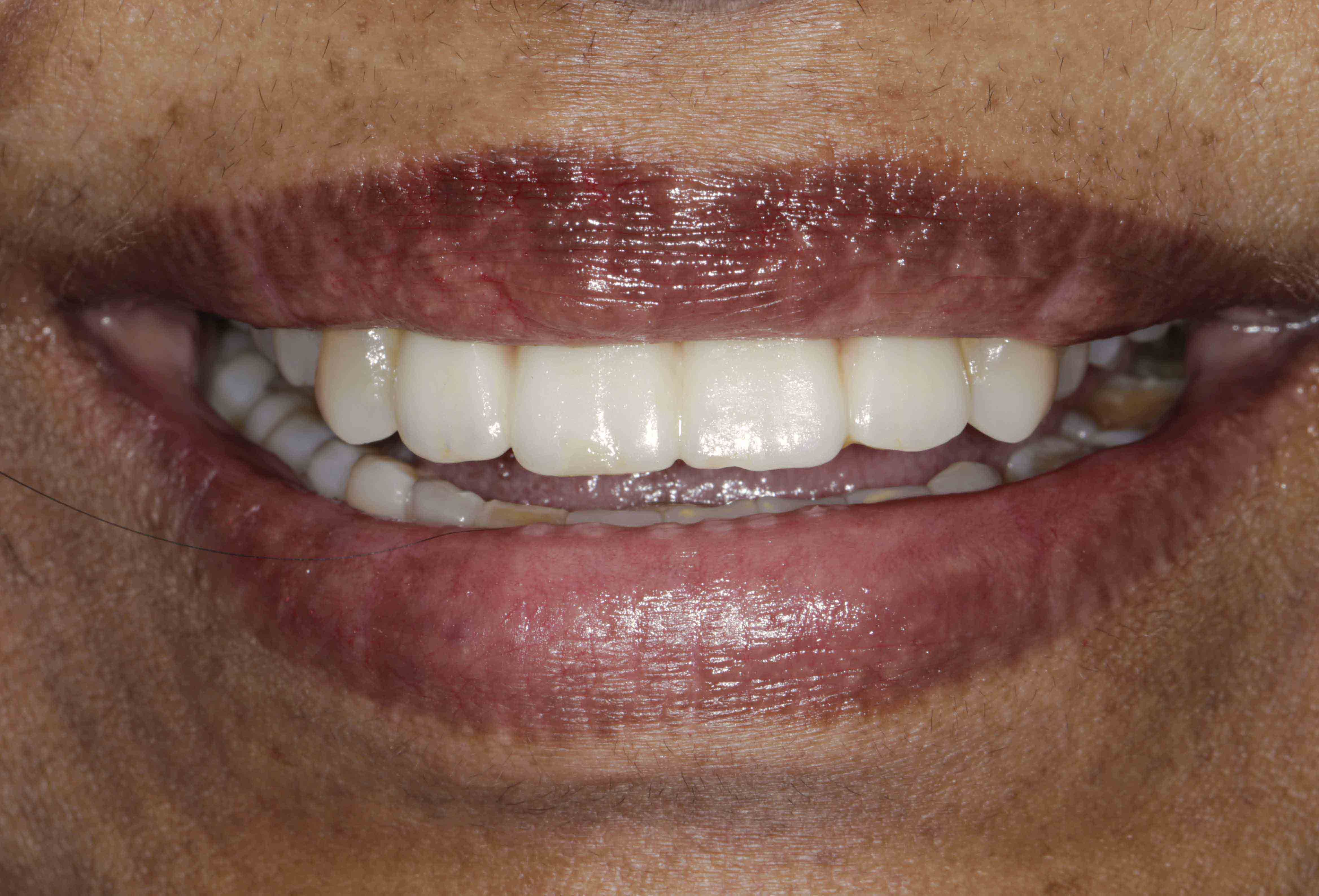 Braces Transformation - After