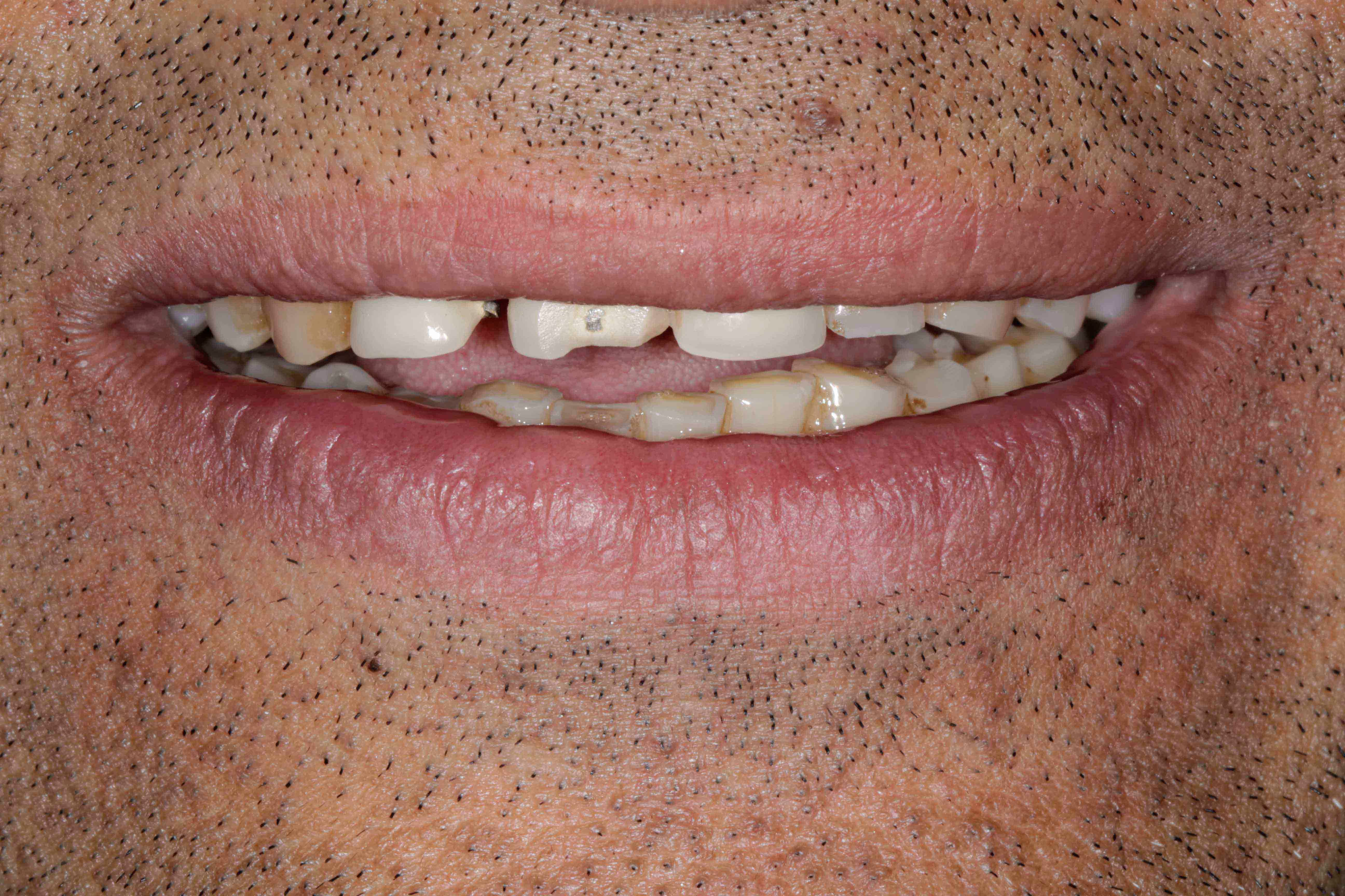 Clear Aligners Result - Before