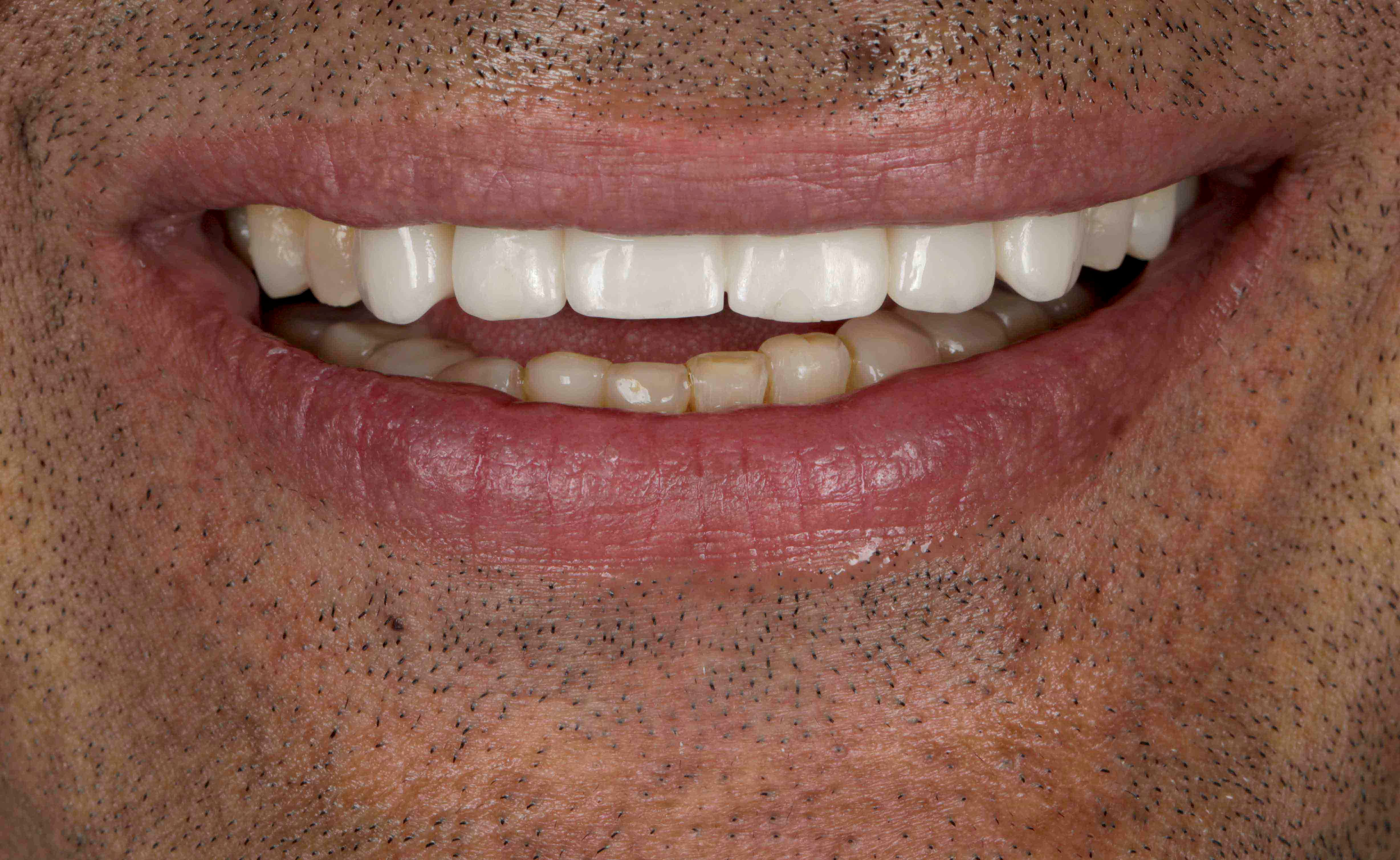 Clear Aligners Result - After