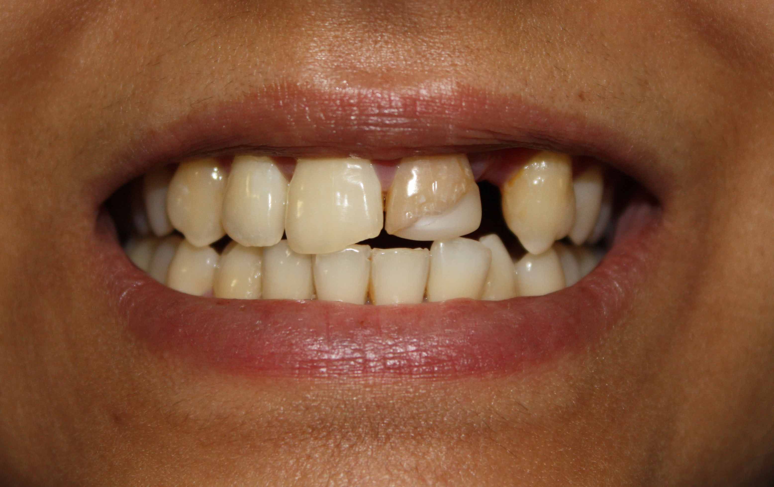 Braces Transformation - Before