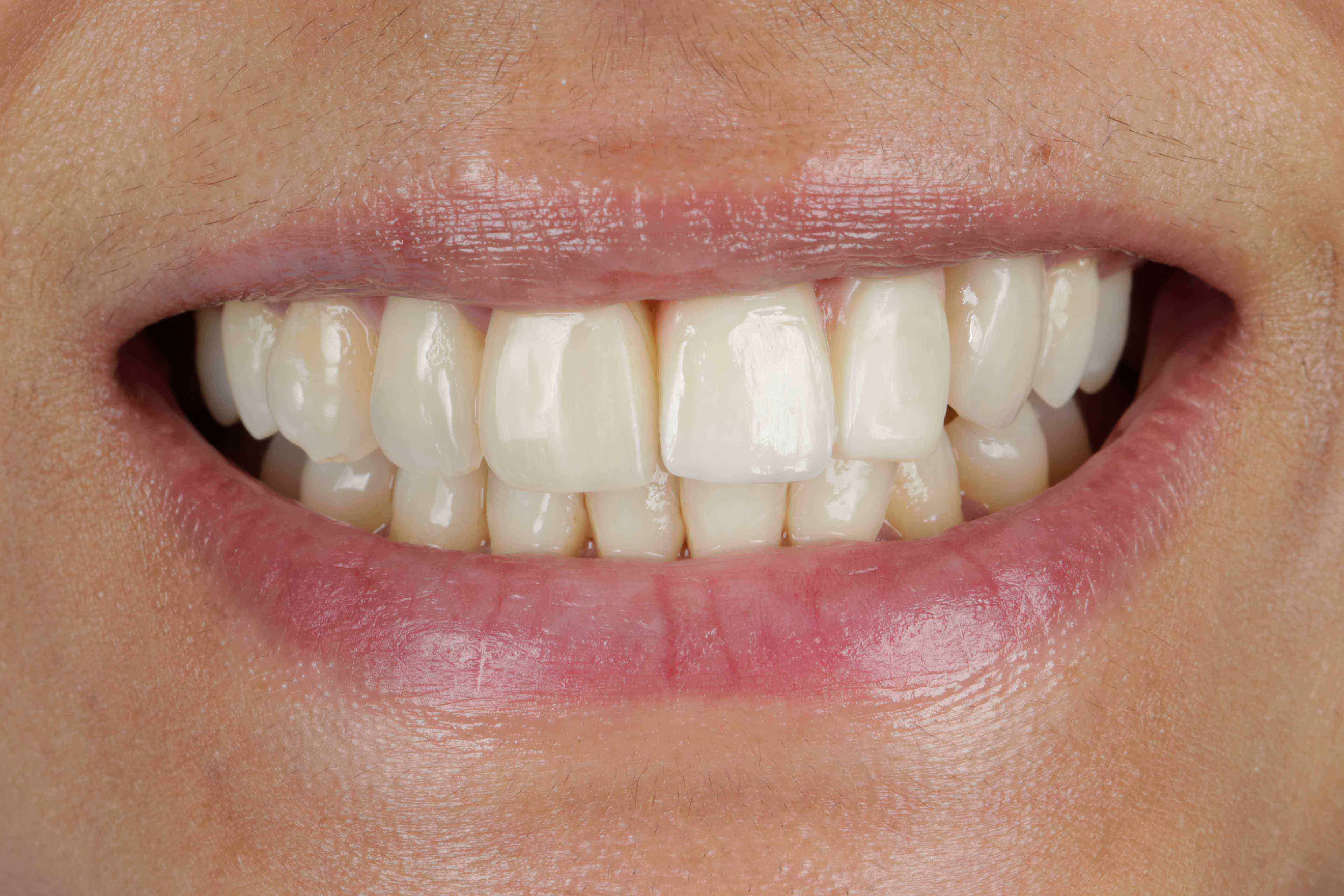 Clear Aligners Result - After