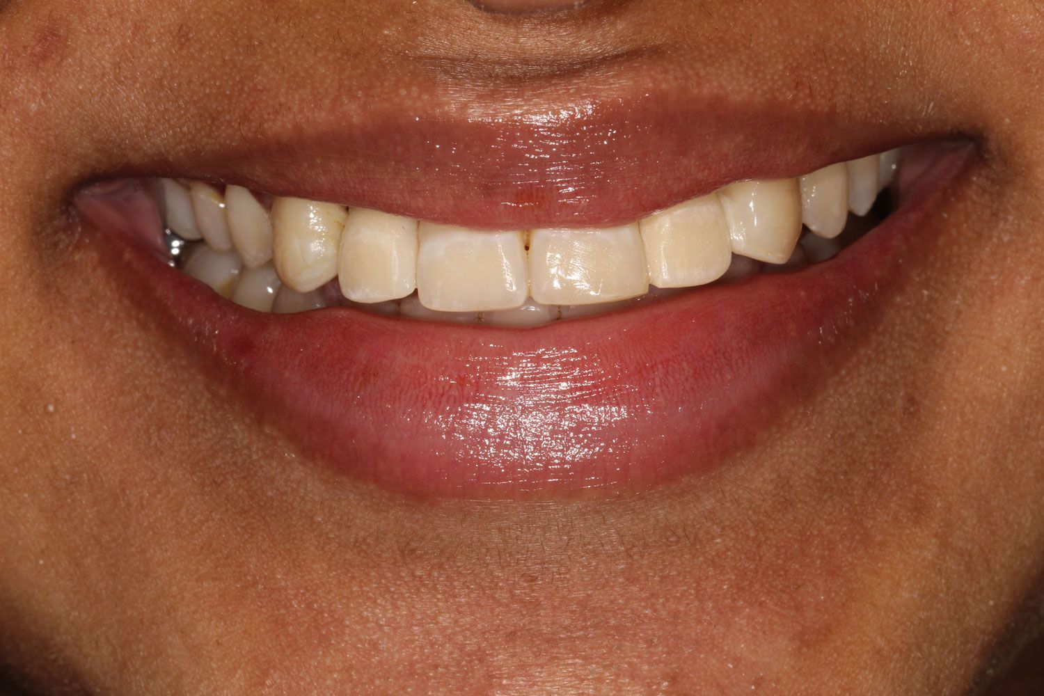 Braces Transformation - After